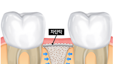 골이식재 없이 차단막만을 이용하여 잇몸뼈 재생 및 형성